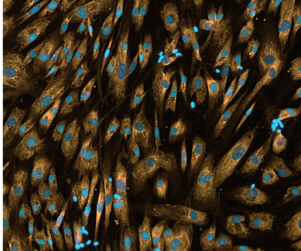 Human Lung Fibroblasts stimulated with TGF-β for 72 hours and immunostained to detect α-SMA, as a measure of extracellular matrix production and deposition.