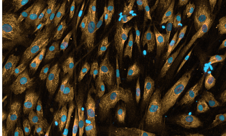 Human Lung Fibroblasts stimulated with TGF-β for 72 hours and immunostained to detect α-SMA, as a measure of extracellular matrix production and deposition.