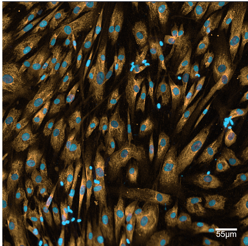 Human Lung Fibroblasts stimulated with TGF-β for 72 hours and immunostained to detect α-SMA, as a measure of extracellular matrix production and deposition.