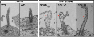 Rp11 patients