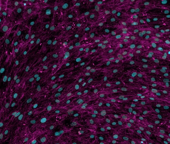 Human Lung Fibroblasts stimulated with TGF-β for 72 hours and immunostained to detect collagen I, as a measure of extracellular matrix production and deposition.