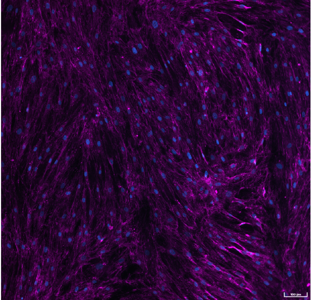 Human Lung Fibroblasts stimulated with TGF-β for 72 hours and immunostained to detect collagen I, as a measure of extracellular matrix production and deposition.